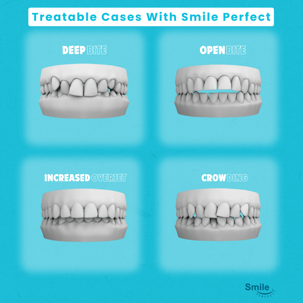 Night-Time Single Arch - Smile Perfect